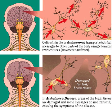 image:alzheimers-disease.jpg